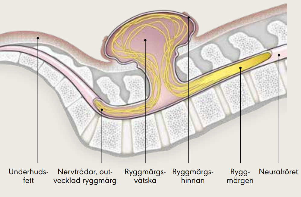 Medicinsk illustration av ryggmärgsbråck